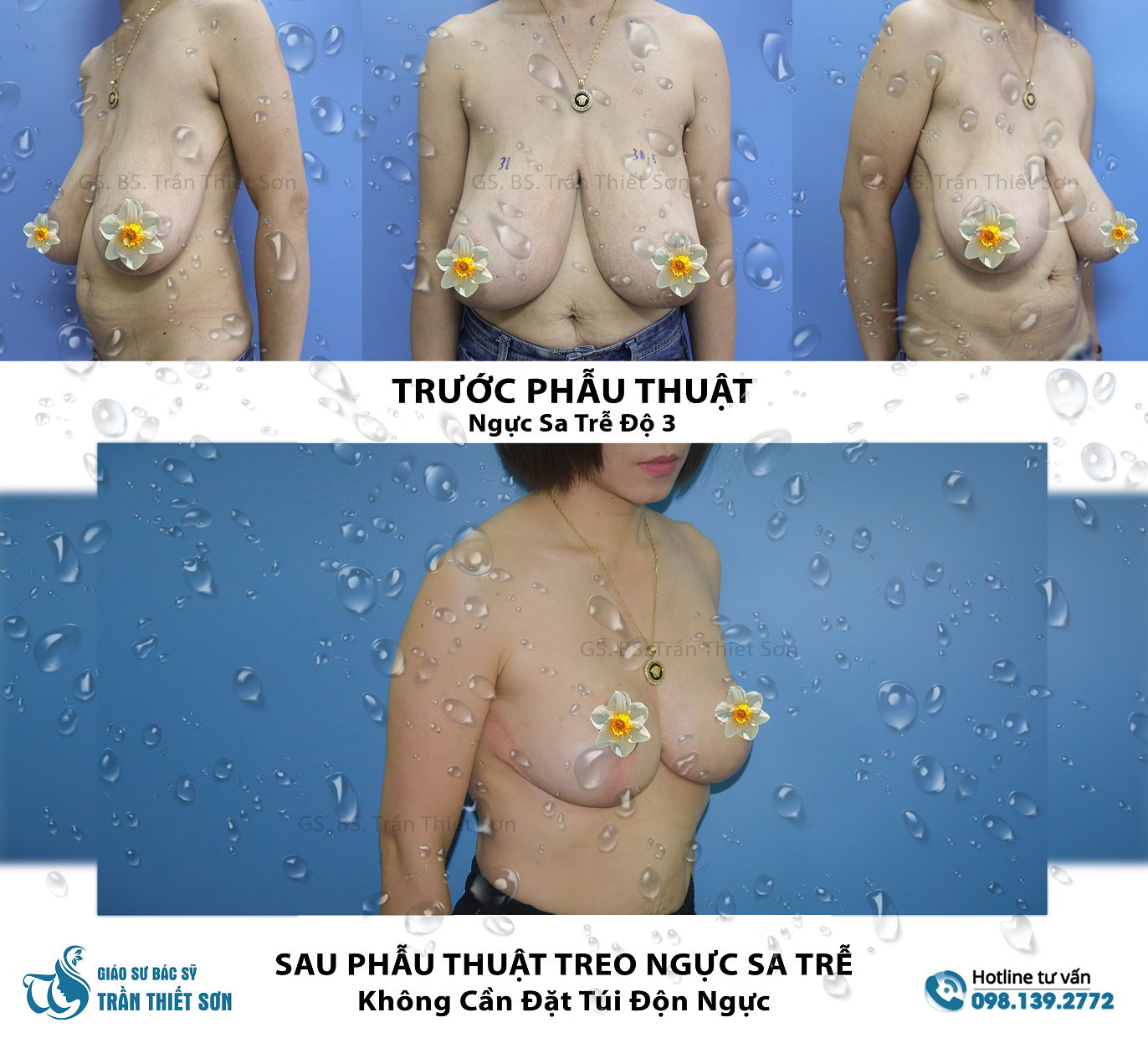 Phẫu Thuật Thu Gọn Ngực