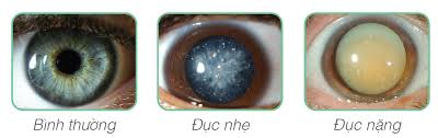Nguyên nhân dẫn đến đục thủy tinh thể