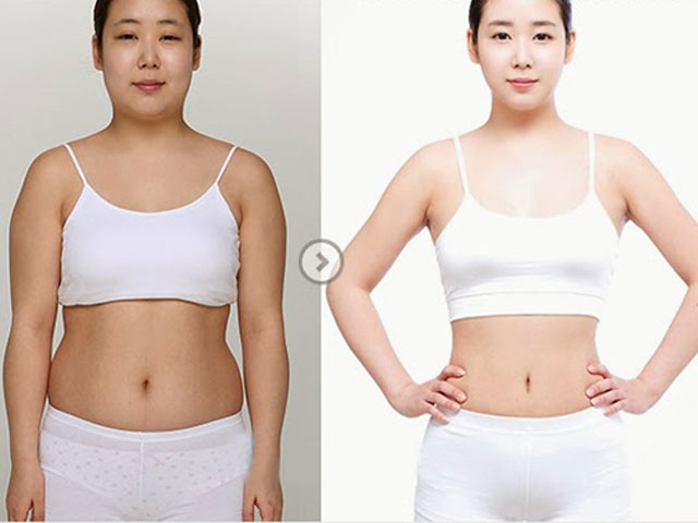 Giảm mỡ bụng