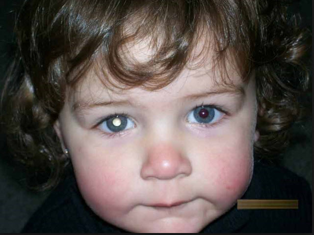 nguyên nhân dẫn đến đục thủy tinh thể 