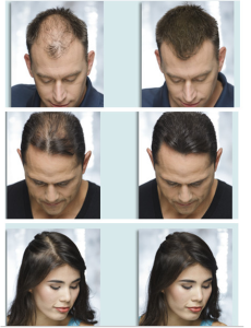 TOPPIK TRỊ TÓC HÓI