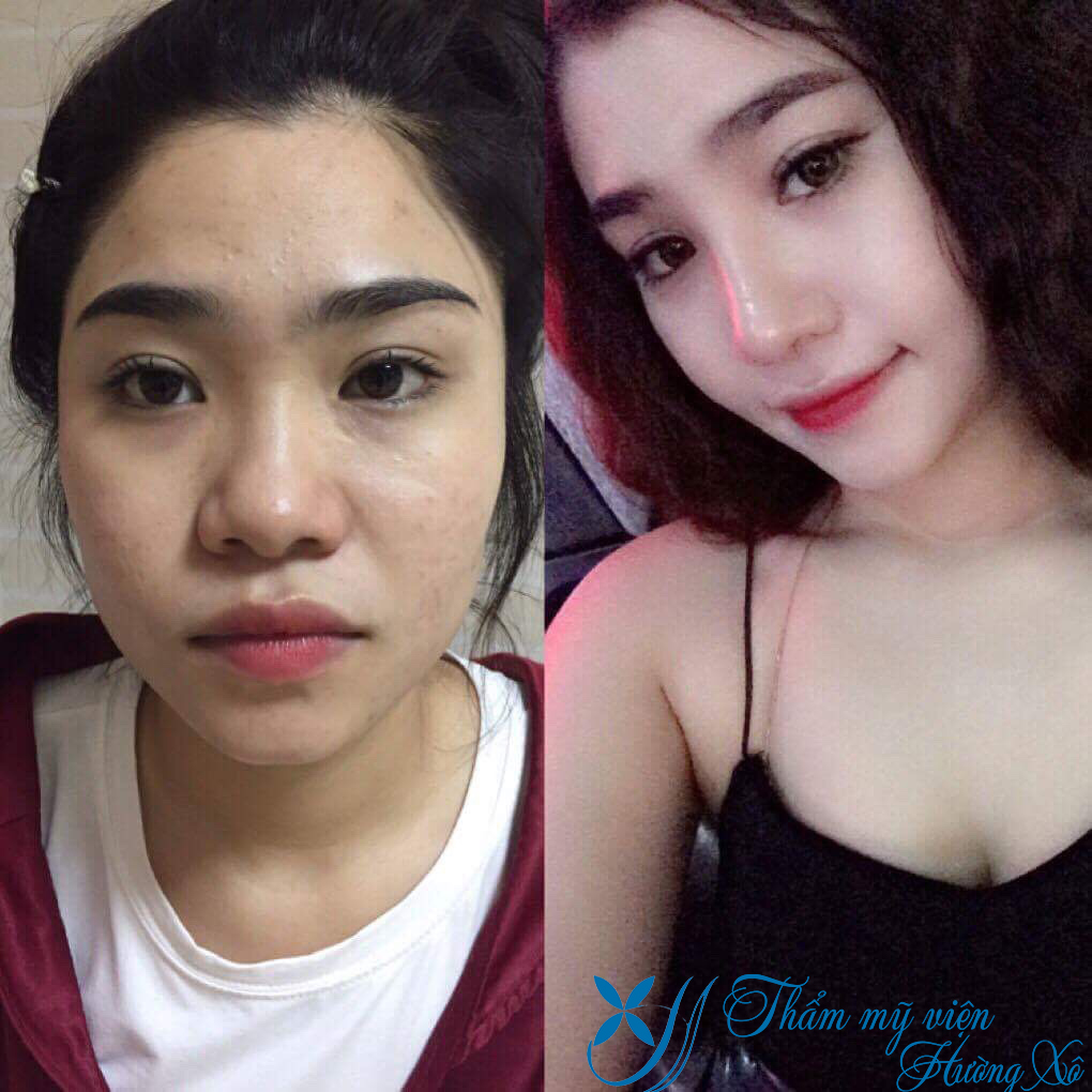 Nâng mũi bán cấu trúc tại Vinh Nghệ AN