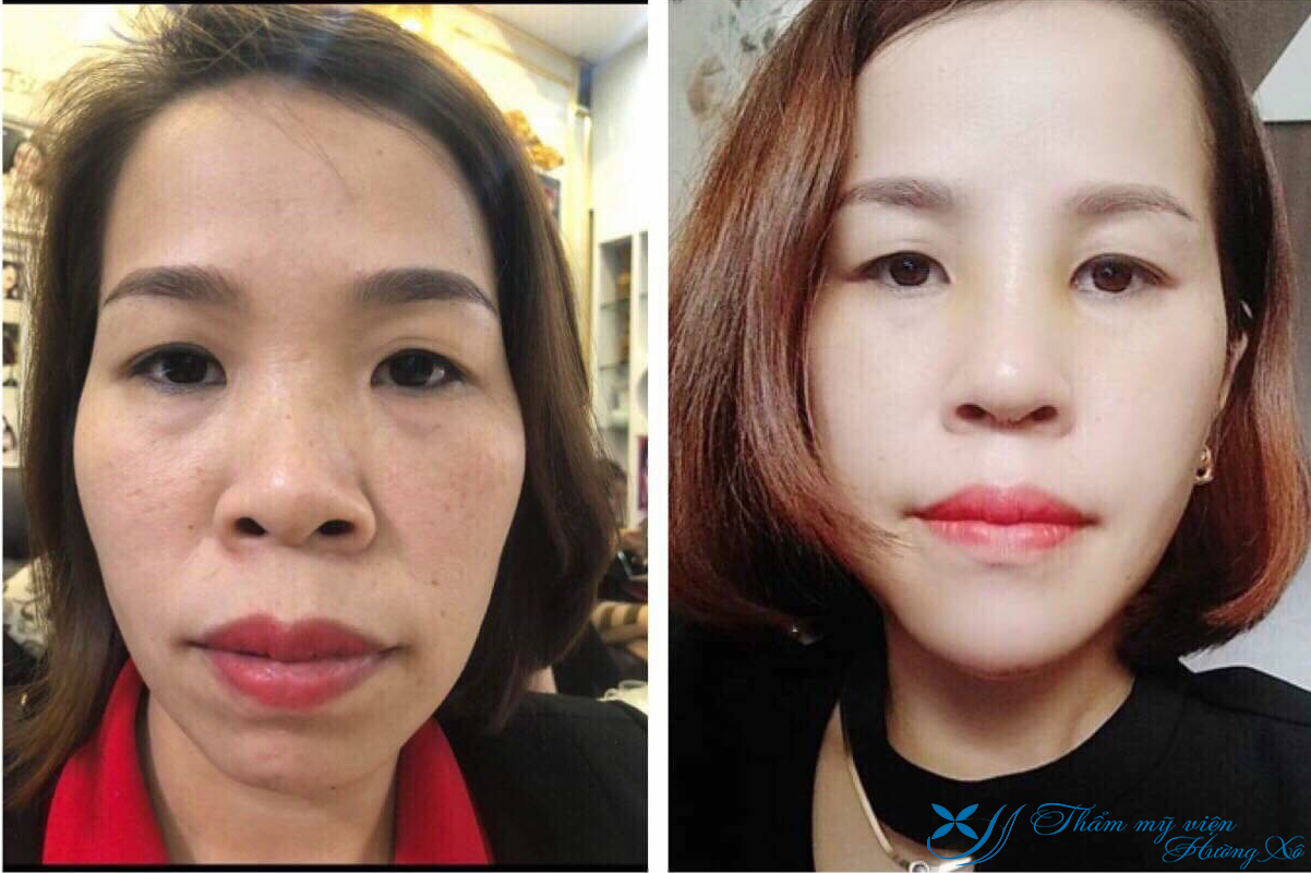 Nâng mũi cấu trúc tại VInh Nghệ An