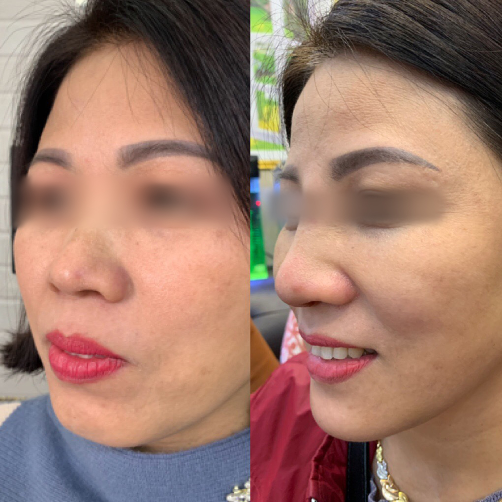 Nâng mũi độn cằm tại Vinh Nghệ An