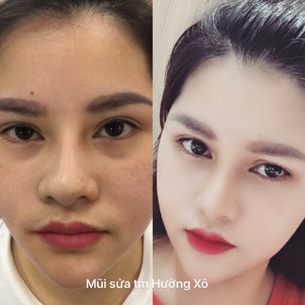 Nâng mũi cấu trúc tại Vinh Nghệ An