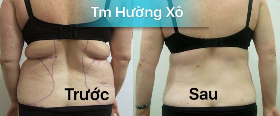 Giảm eo - đánh tan mỡ tại Vinh Nghệ AN