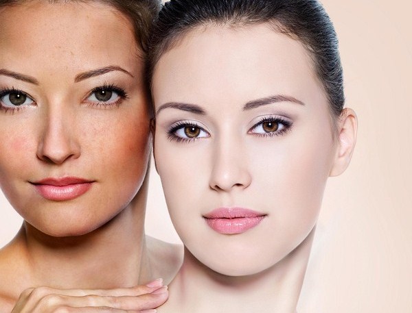 Điều trị nám da tại Vinh Nghệ An