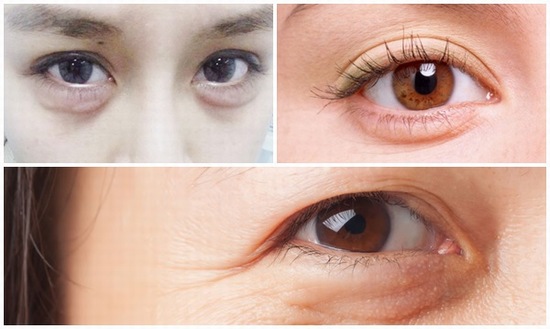 Lấy mỡ bọng mắt tại Vinh Nghệ An