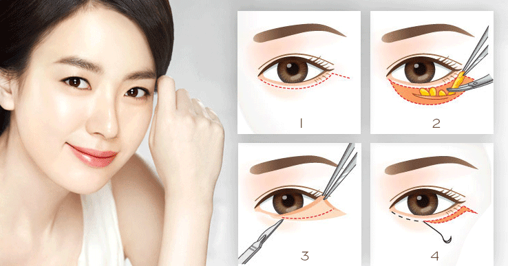 Lấy mỡ bọng mắt tại Vinh Nghệ An