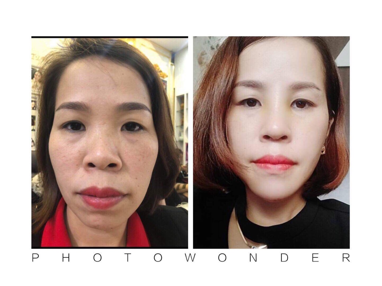 phẫu thuật thẩm mỹ