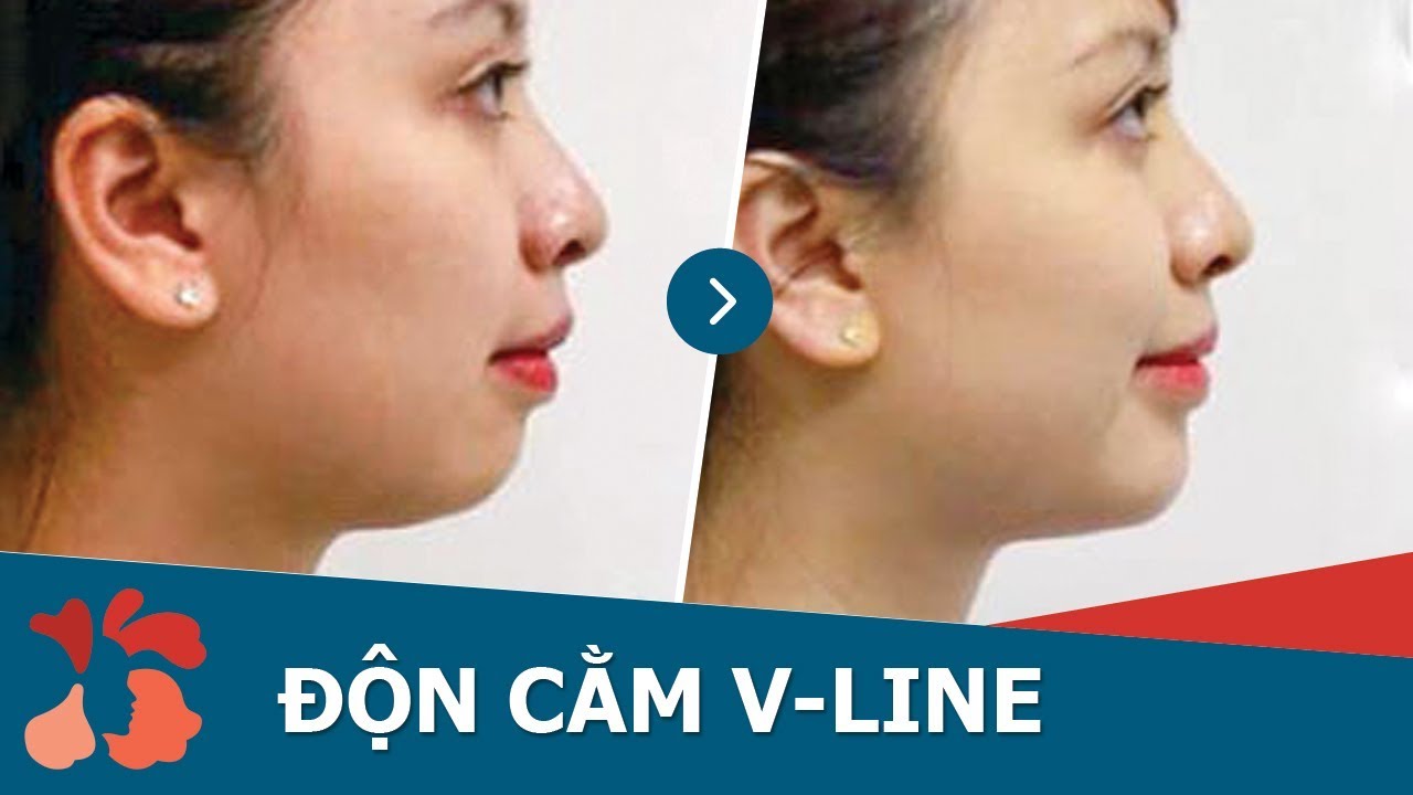 phẫu thuật độn cằm tại nghệ an