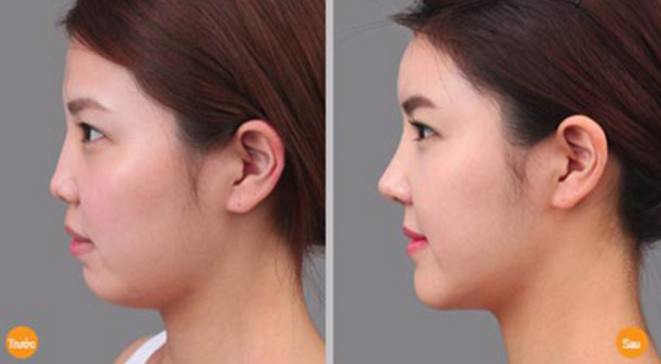 phẫu thuật độn cằm tại nghệ an