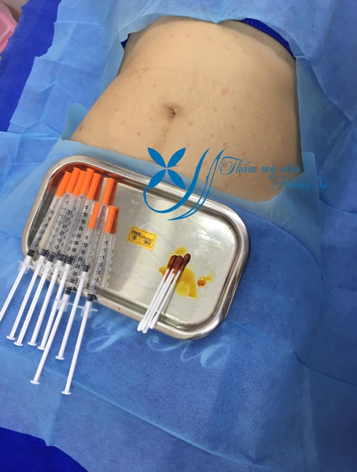 giảm béo bằng Smart Lipo tại Thành Phố Vinh