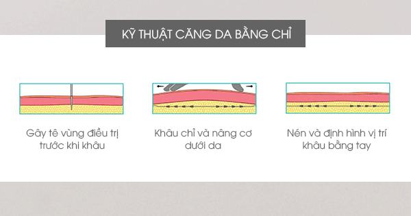 căng gia mặt bằng chỉ collagen tại vinh