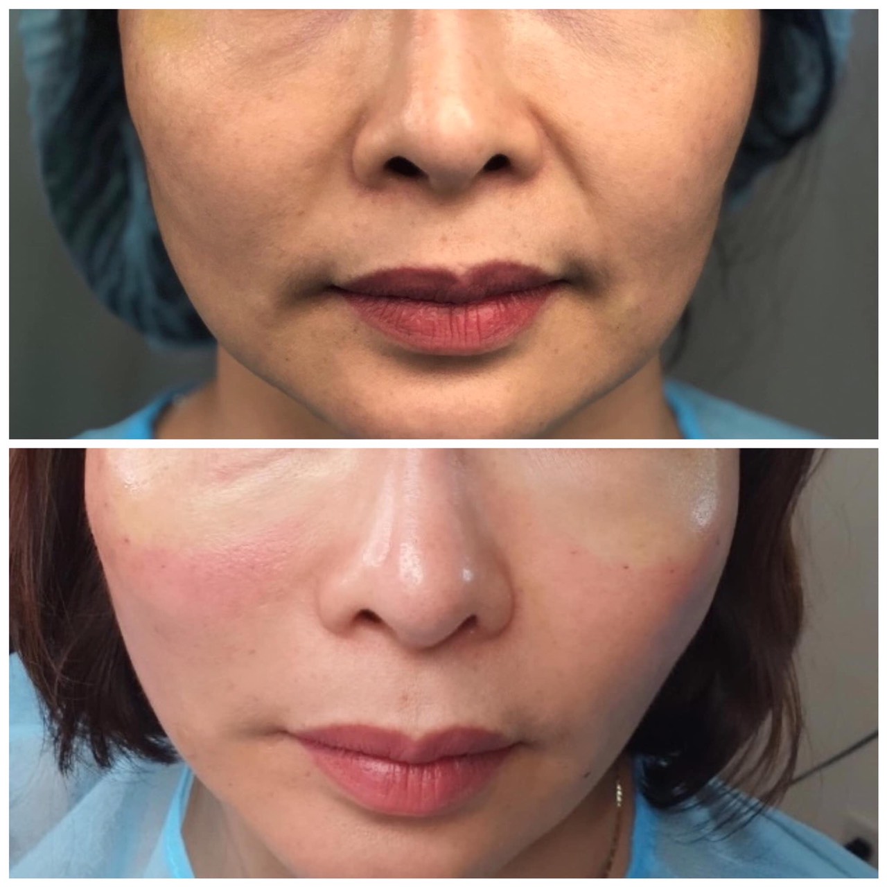 căng gia mặt bằng chỉ collagen tại vinh
