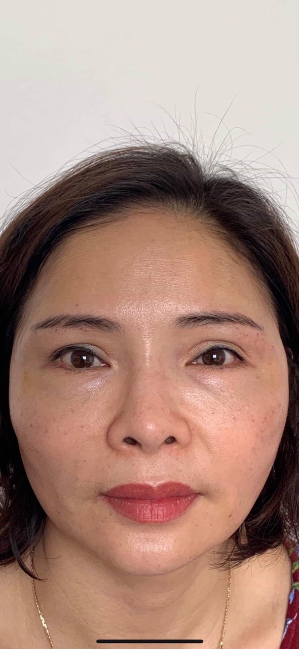 căng gia mặt bằng chỉ collagen tại vinh