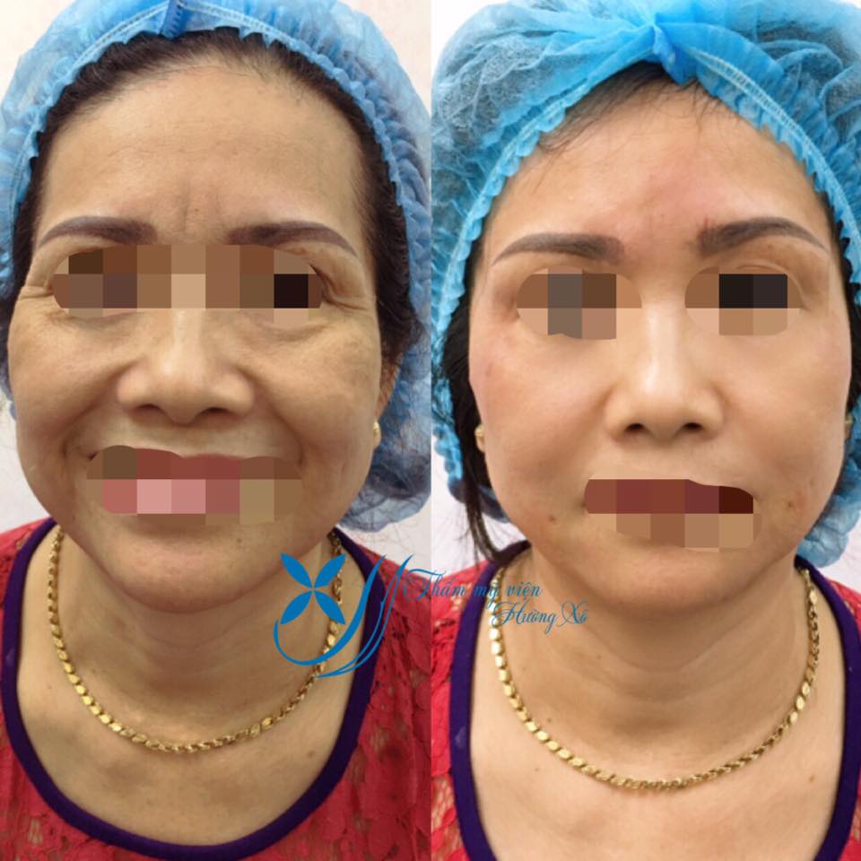 căng gia mặt bằng chỉ collagen tại vinh