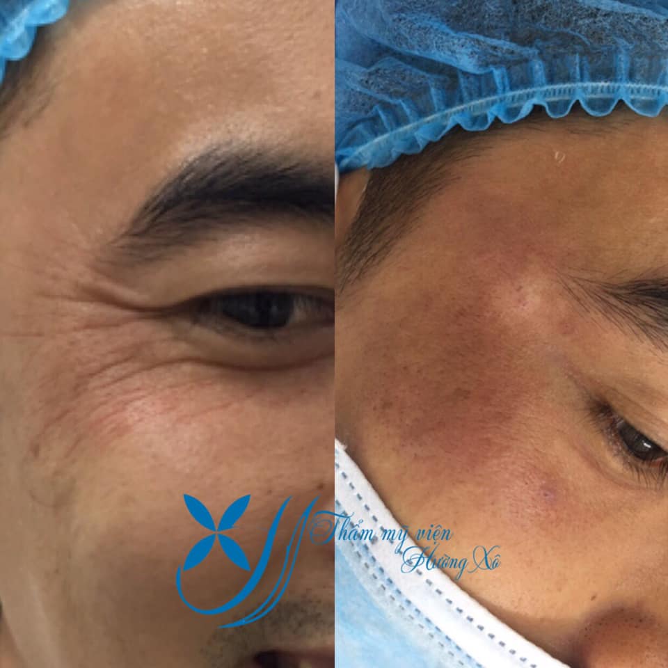 Căng da mặt bằng chỉ Ultra V-lift tại Vinh