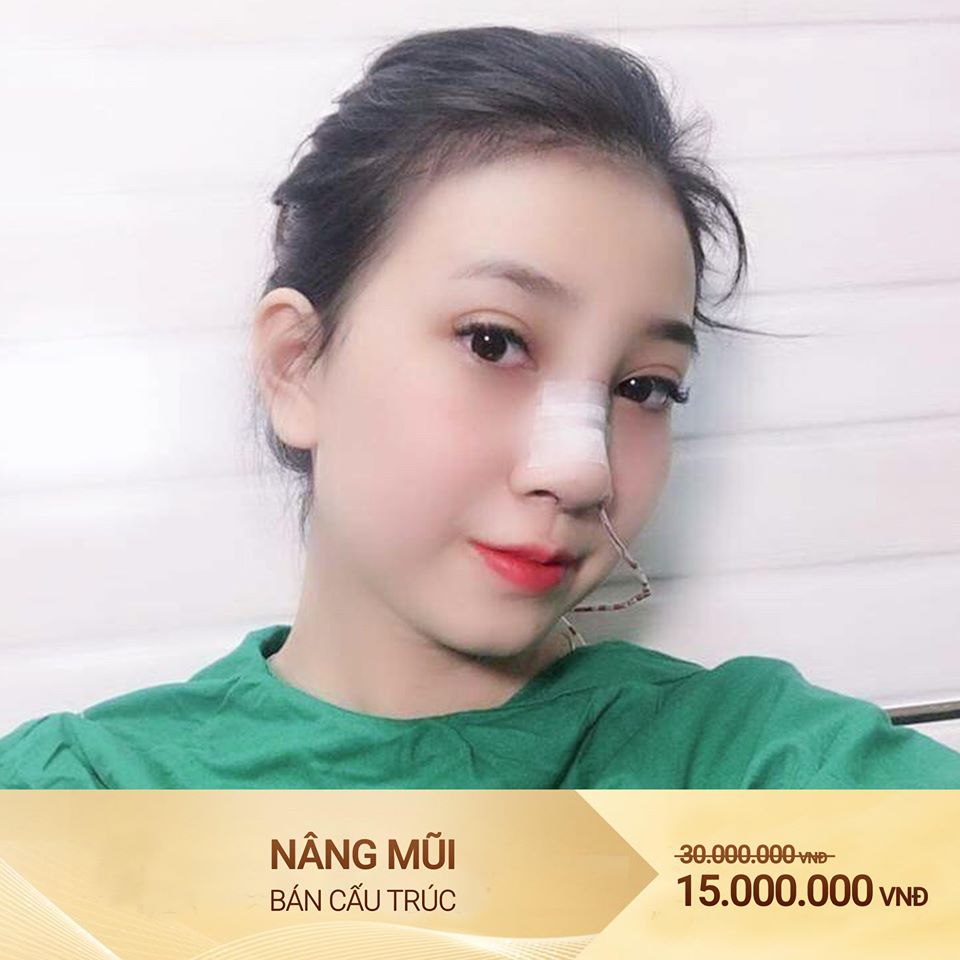 nâng mũi tại vinh