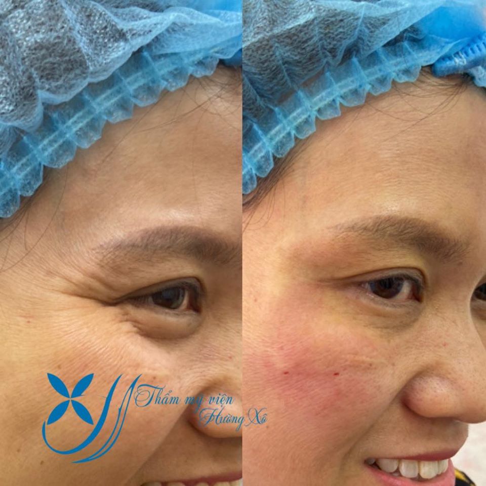 căng da bằng chỉ collagen tại vinh