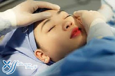 Cắt mí nội soi tại Vinh