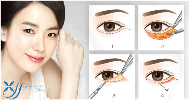 Cắt mí nội soi tại Vinh