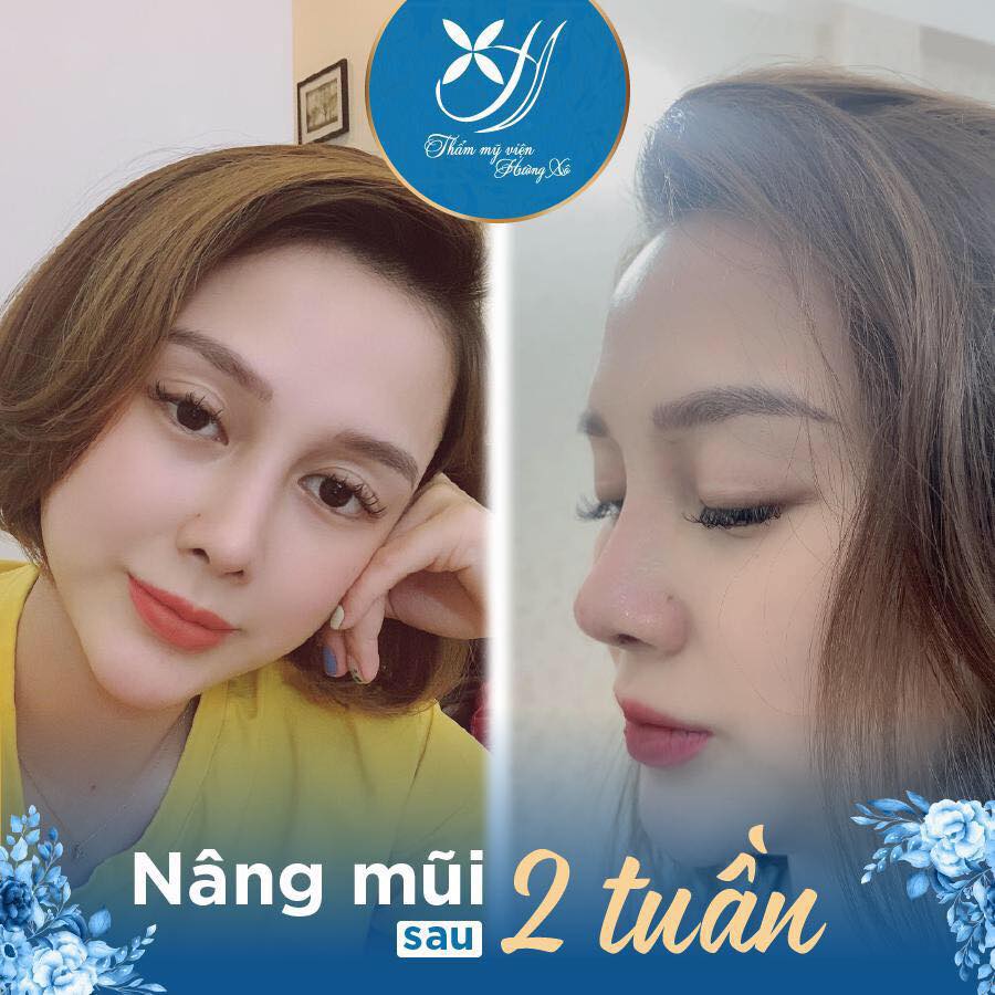 nâng mũi cấu trúc tại Vinh