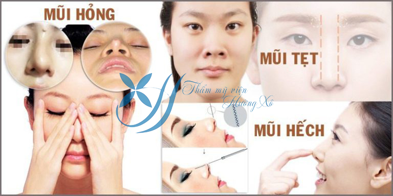 nâng mũi cấu trúc tại Vinh