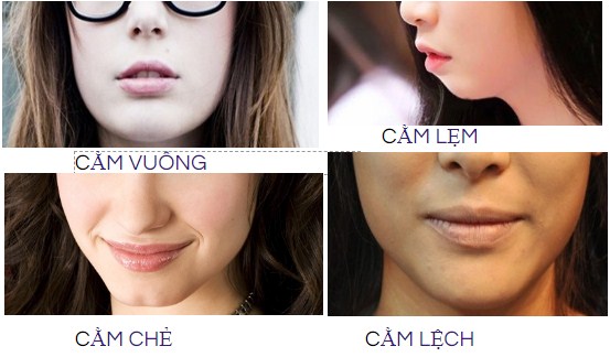 độn cằm tại vinh