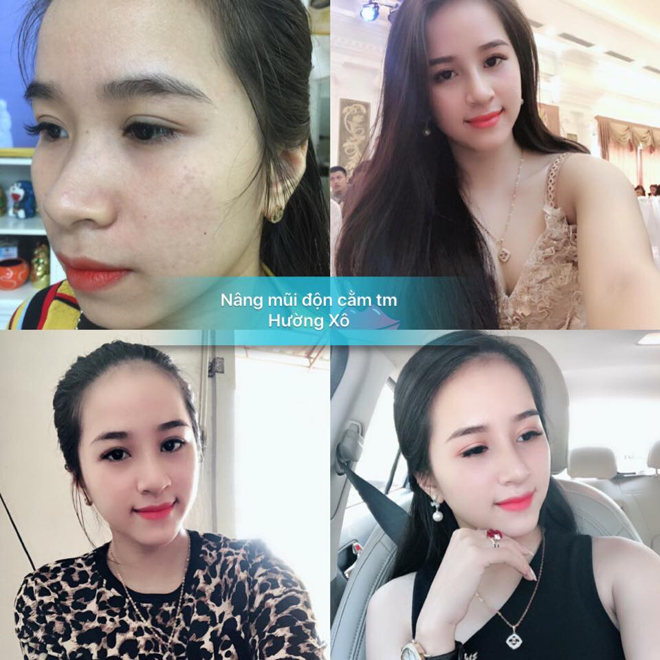 Phẫu thuật thẩm mỹ tại Hà Tĩnh