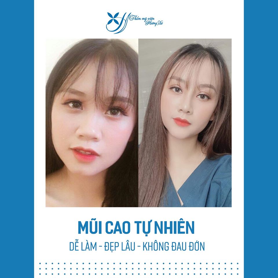 nâng mũi tại vinh