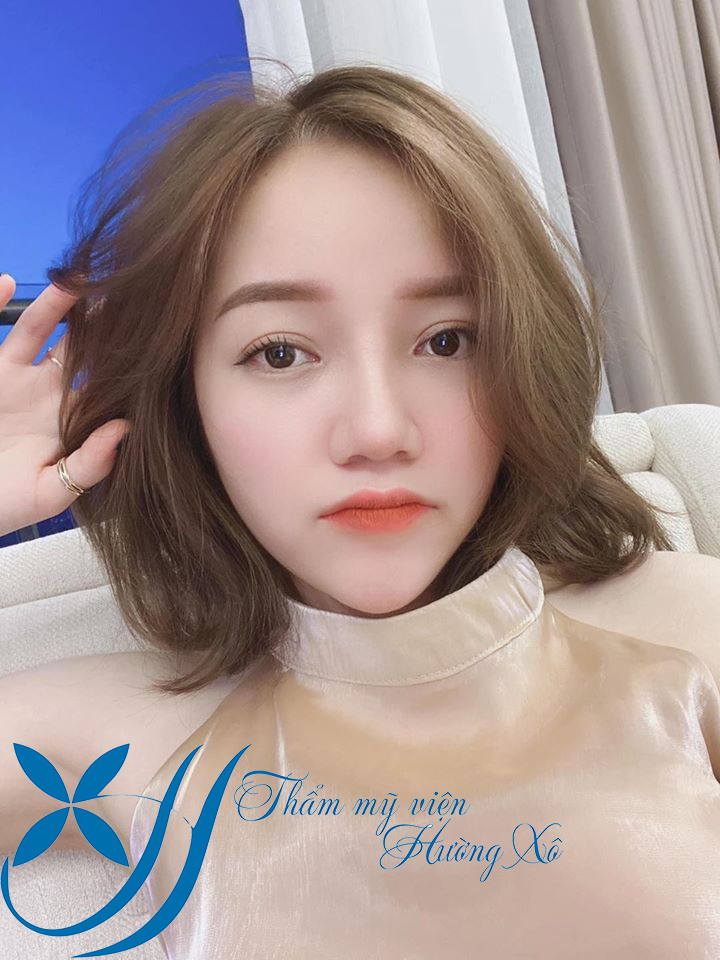 nâng mũi tại vinh