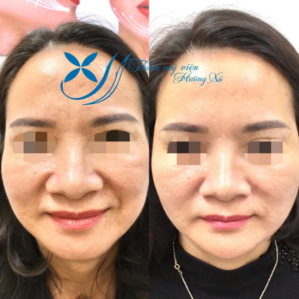 Căng da bằng chỉ collagen tại Hà Tĩnh