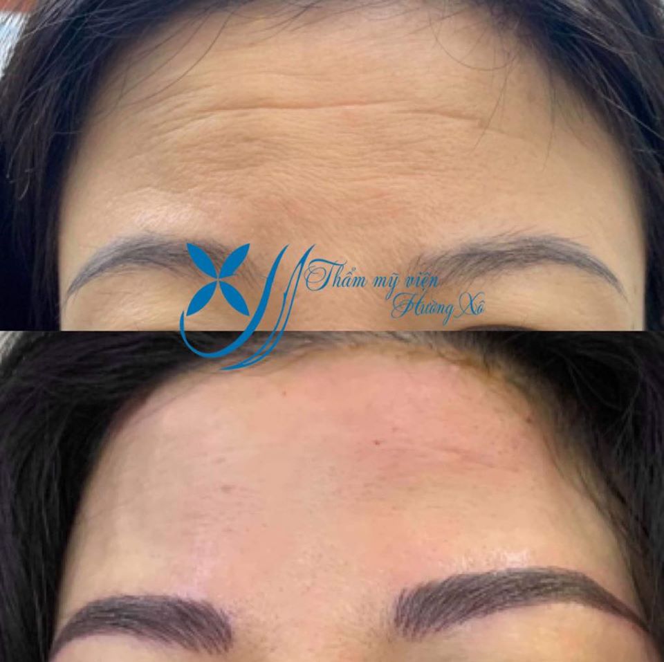 Khách hàng căng da bằng chỉ collagen tại Hà Tĩnh