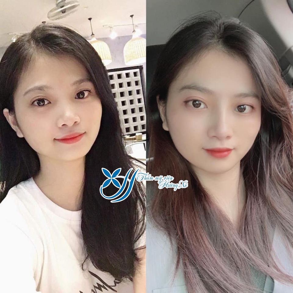 Nâng mũi bán cấu trúc tại Vinh, Nghệ An