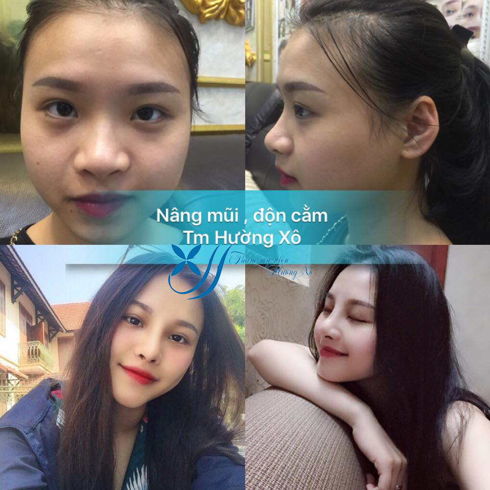 Nâng mũi bán cấu trúc tại Vinh, Nghệ An