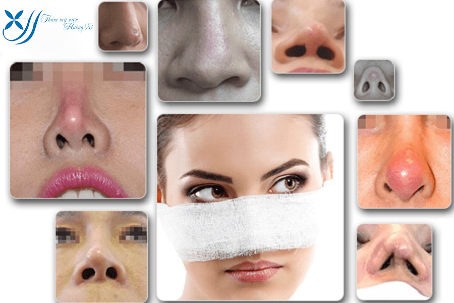 Sửa mũi tại Hà Tĩnh