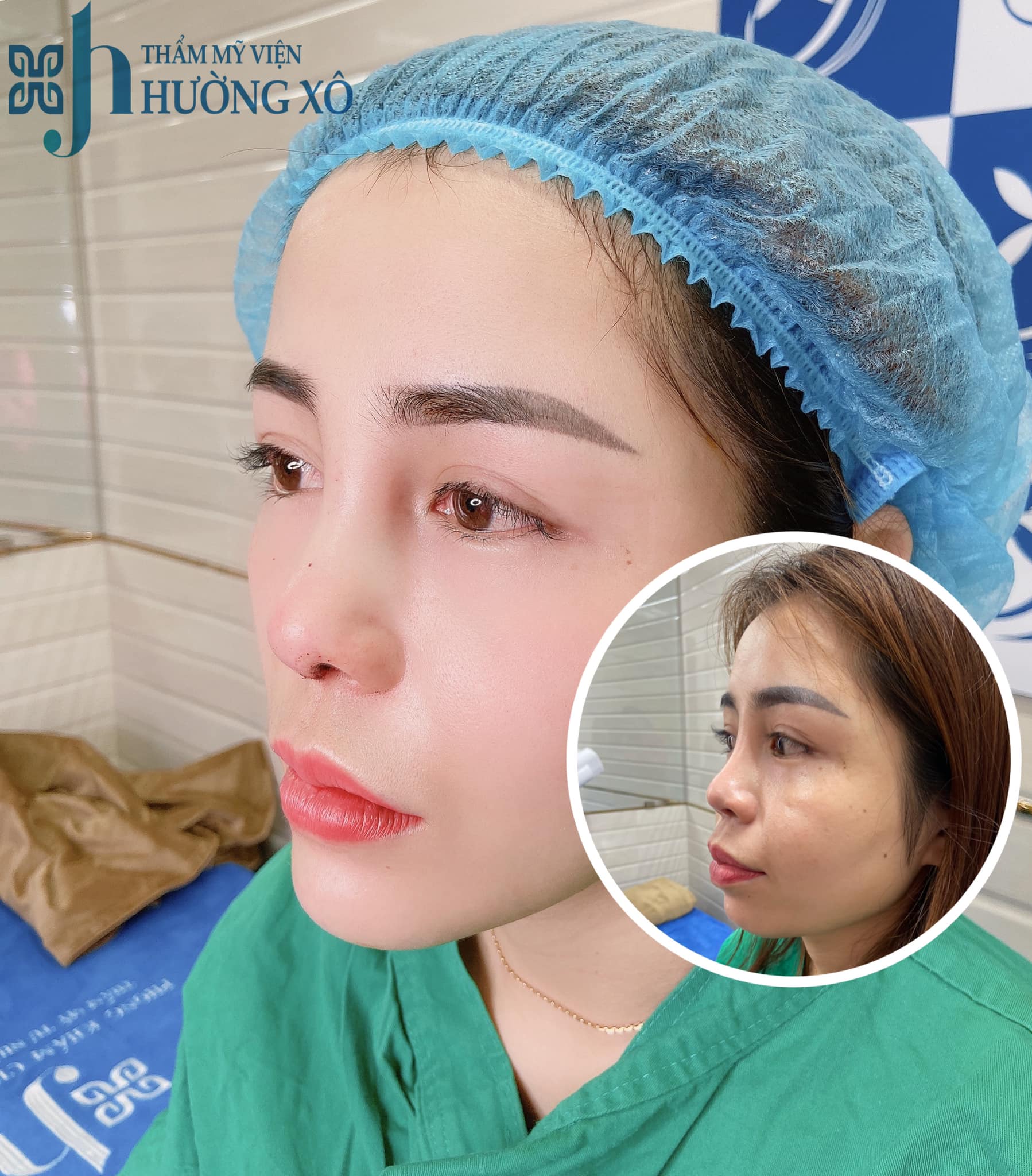 phẫu thuật độn cằm tại Nghệ An