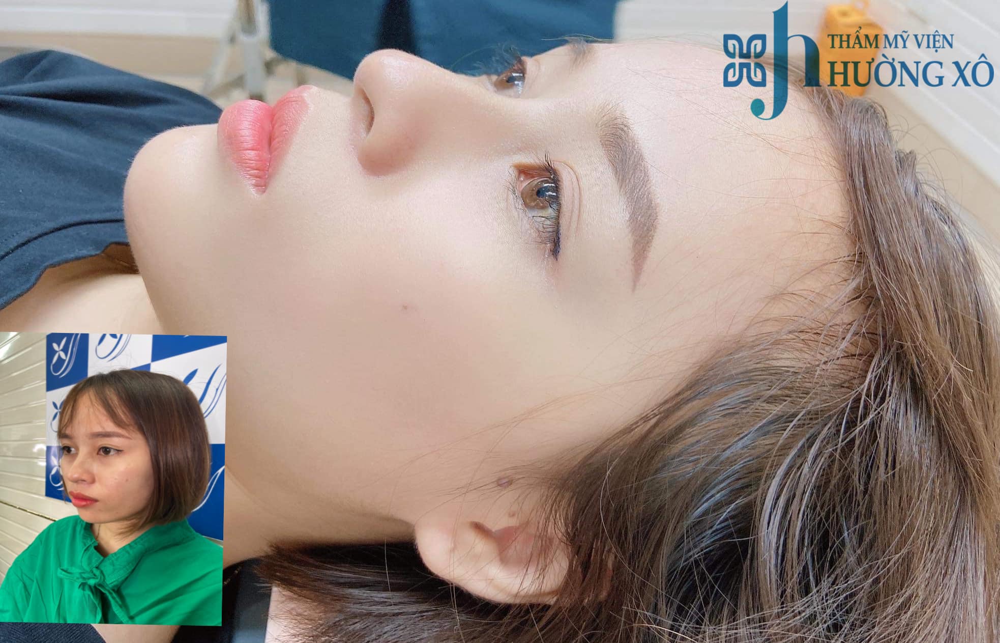 phẫu thuật độn cằm tại nghệ an