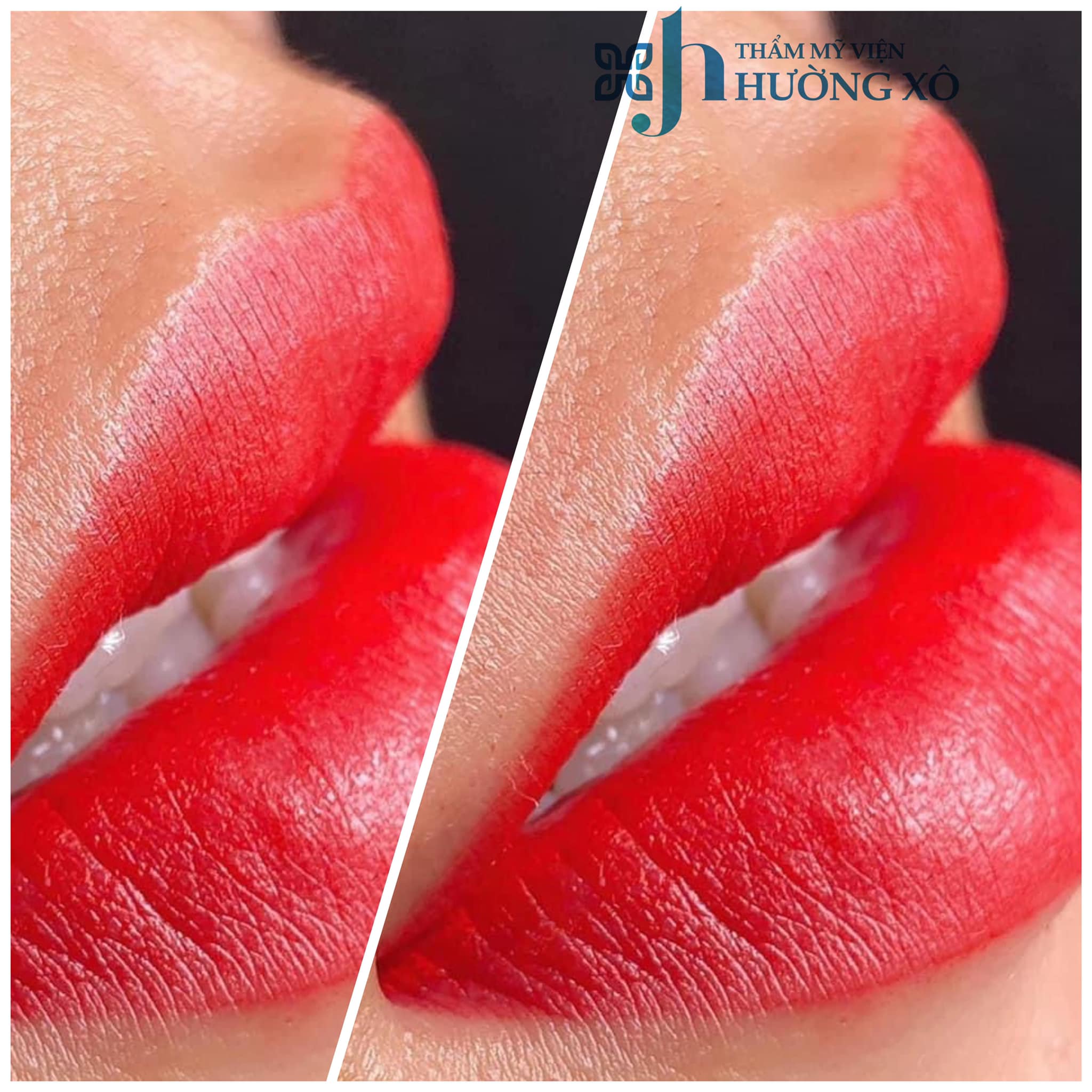 phun môi collagen tại vinh, nghệ an