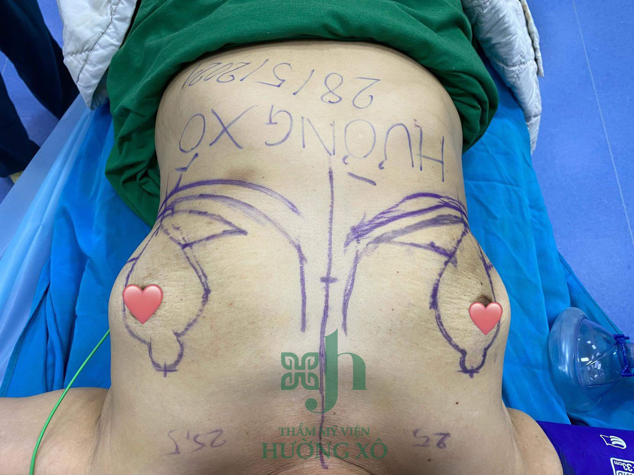 Hút Mỡ Vaser Lipo - Nâng Ngực Nano Chip tại Vinh, Nghệ An