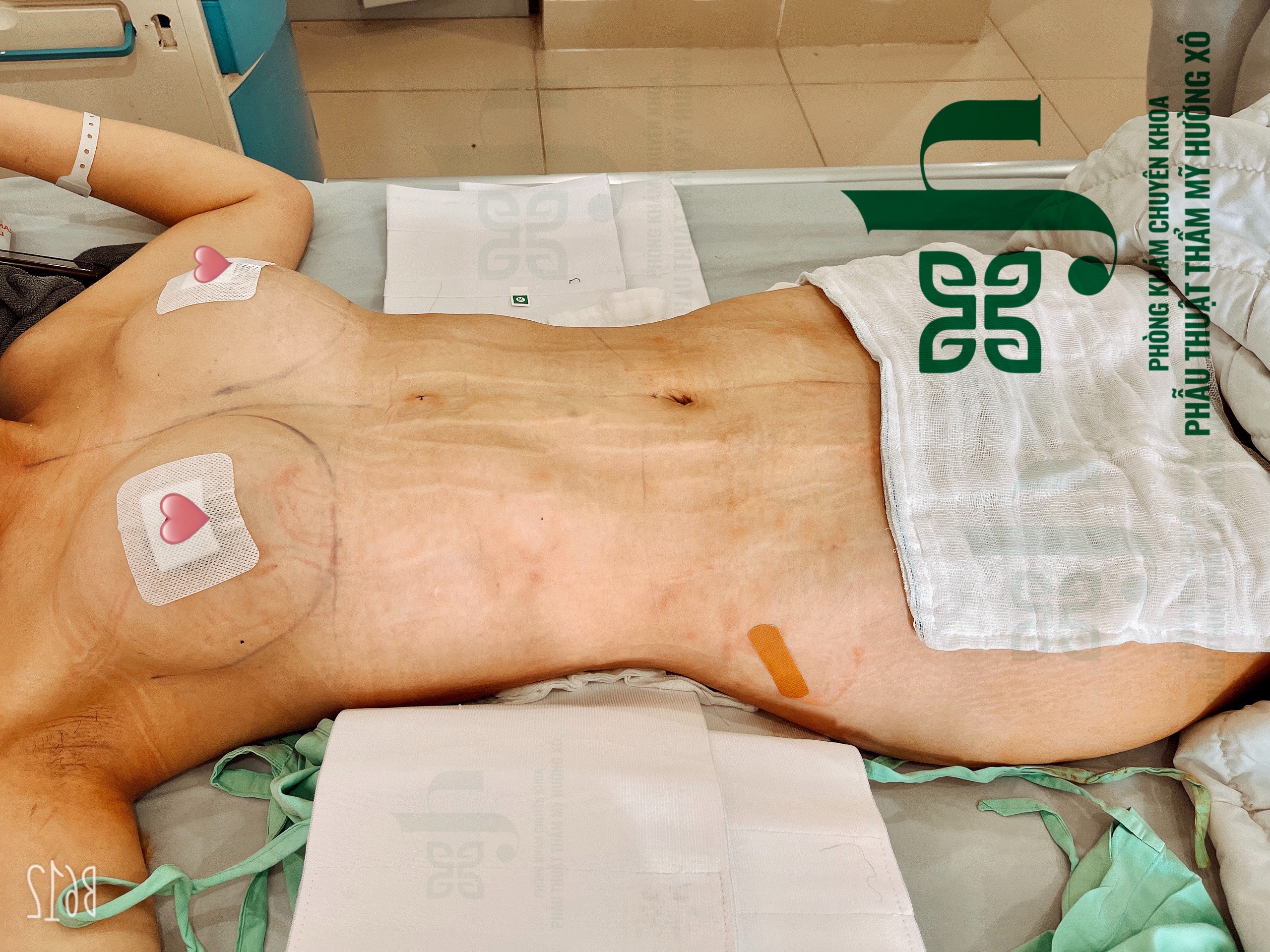 Hút Mỡ Vaser Lipo - Nâng Ngực Nano Chip tại Vinh, Nghệ An