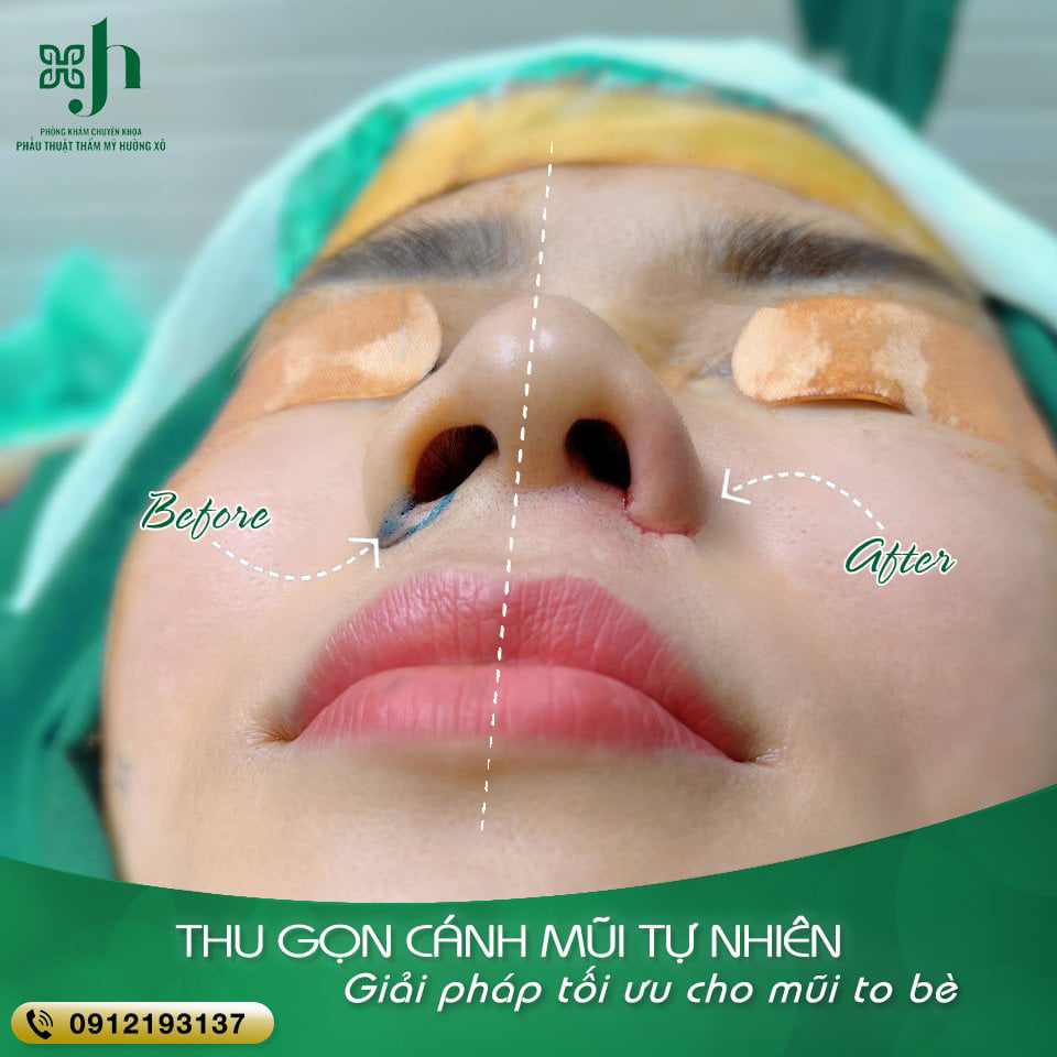thu gọn cánh mũi tại vinh nghệ an