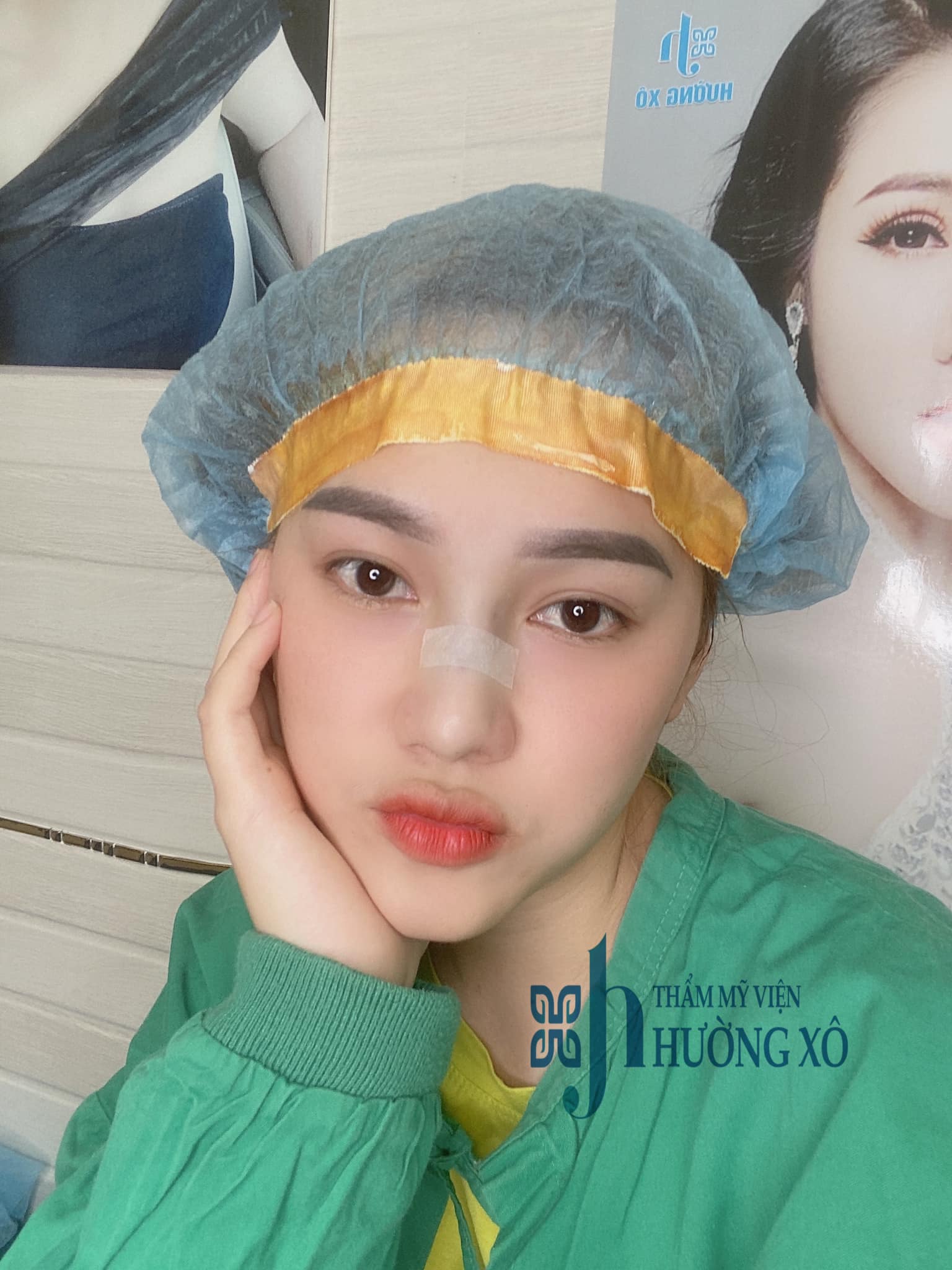 thu gọn cánh mũi tại vinh nghệ an