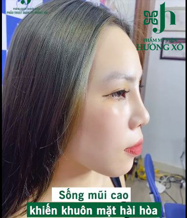 nâng mũi tại vinh nghệ an