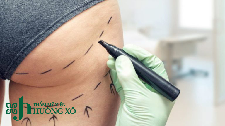 nâng mông bằng túi độn tại vinh