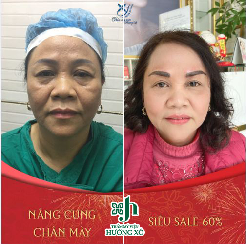 nâng cung mày tại Vinh, Nghệ An