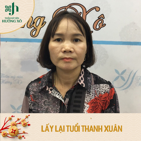 nâng cung mày tại Vinh, Nghệ An