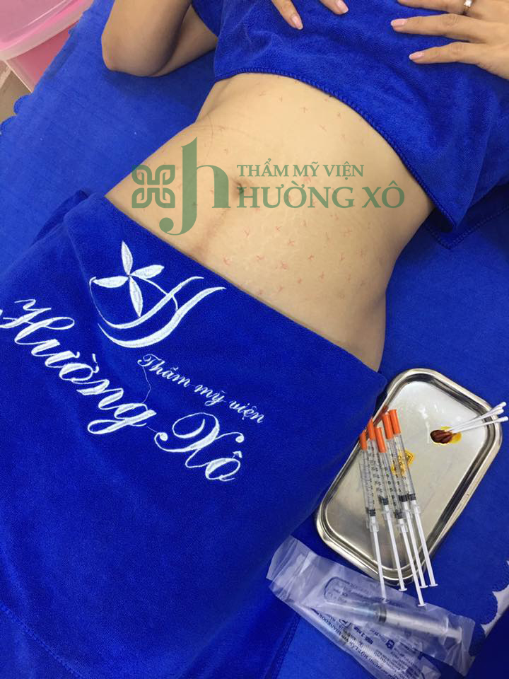 tiêm tan mỡ, hút mỡ tại vinh nghệ an