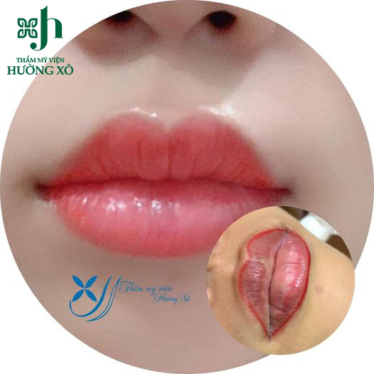 phun môi collagen tại vinh, nghệ an